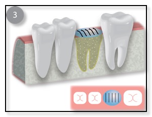 Bone grafting and membran diagram